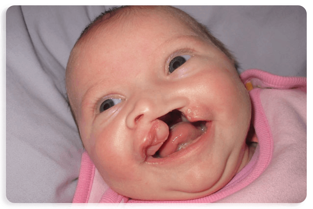 Cleft Lip & Palate