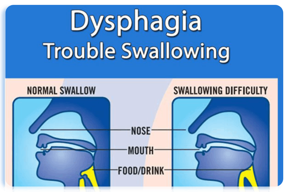 Dysphagia (Swallowing Problem)