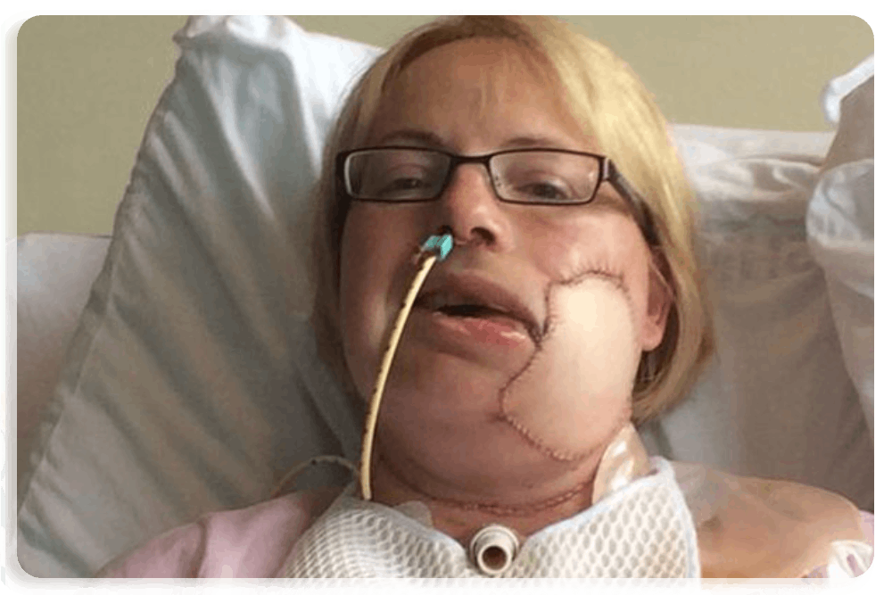 Post Oral Cancer Rehabilitation