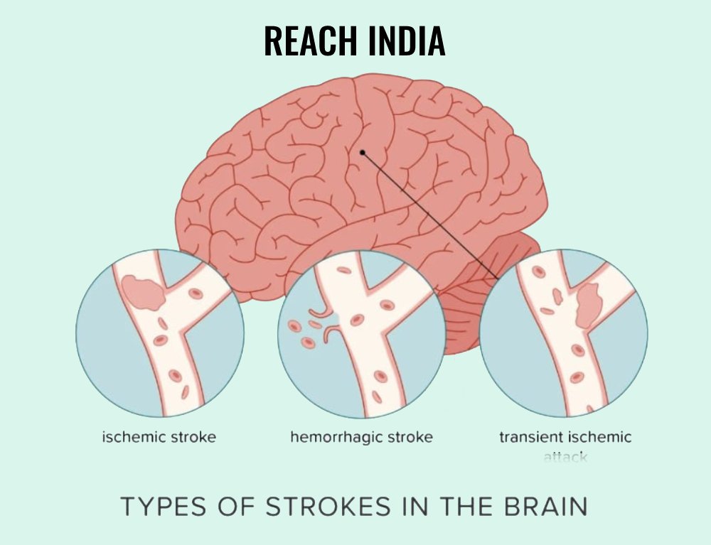 Types of Stroke